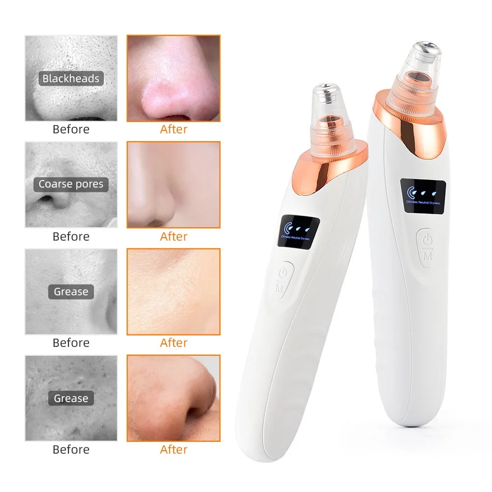 Elite Blackhead Suction Vaccum Extractor