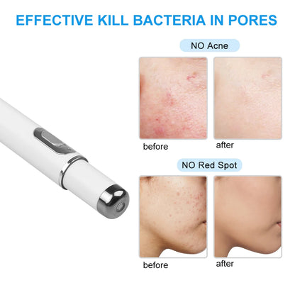 Ultra Blue Light Laser Acne Removal Pen